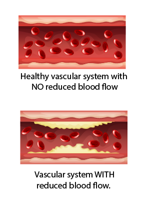 Ischemic Vascular Disease and Aspirin: What's the Relationship?